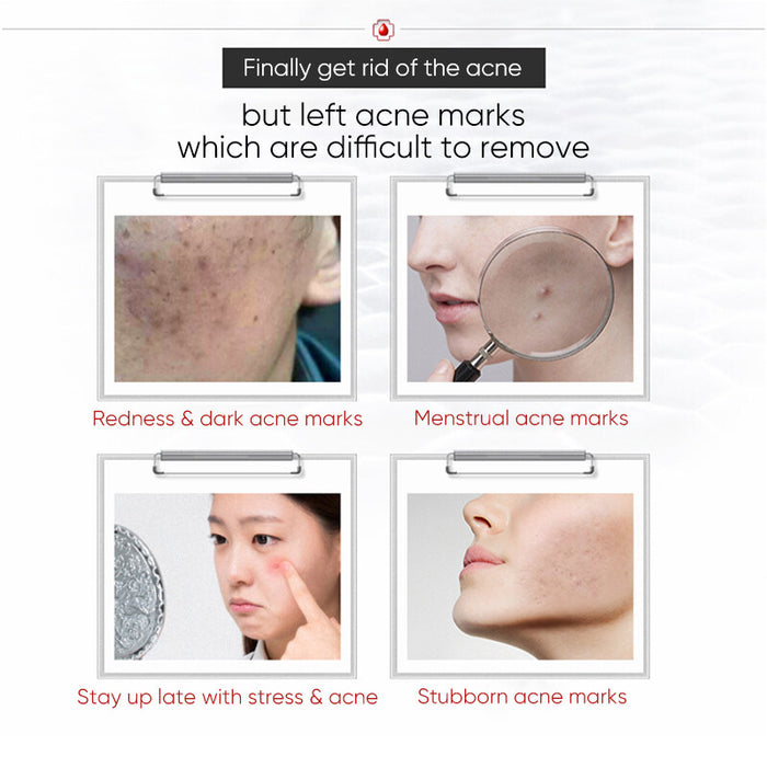 WINONA Anti-Acne Series Brighten Clearing Face Cream T2192